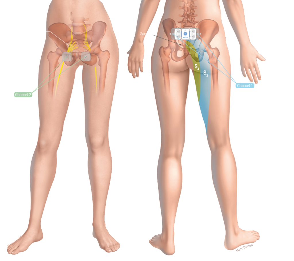 actiTENS offers TENS and EMS mode stimulation programs designed to alleviate endometriosis pain, providing targeted relief.